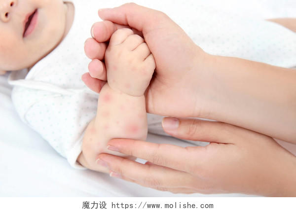 母亲牵着小孩子的手红疹特写美容皮肤